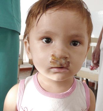 Tadschikisches Kind nach erfolgreicher OP